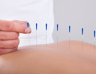 ACUPUNTURA